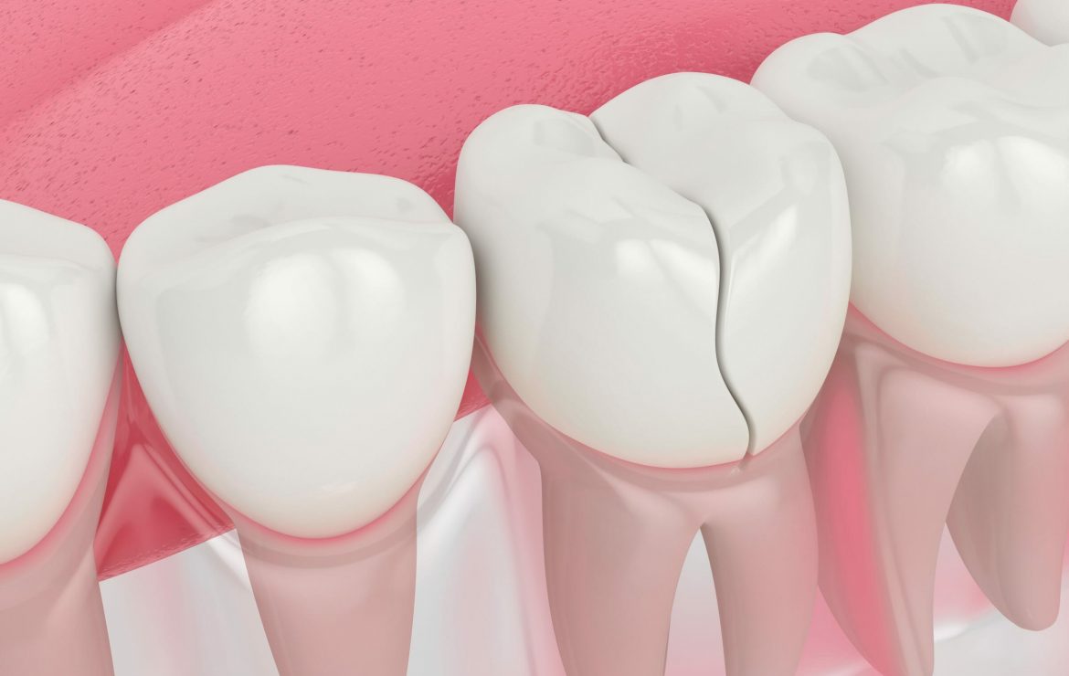 5 Dental Procedures to Repair Your Cracked or Broken Tooth