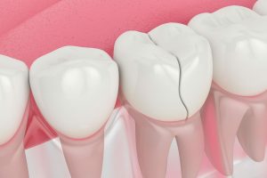 5 Dental Procedures to Repair Your Cracked or Broken Tooth