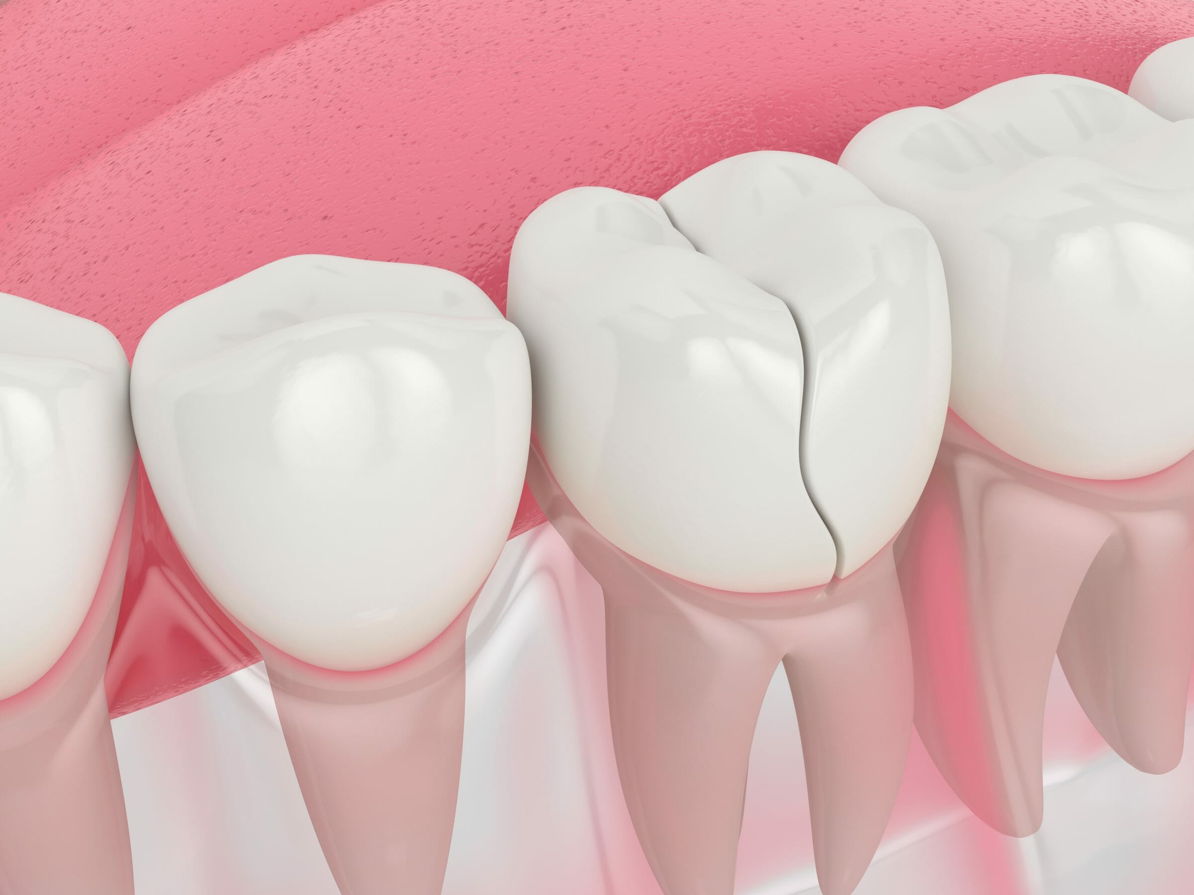 Procedures to Repair Your Cracked or Broken Tooth
