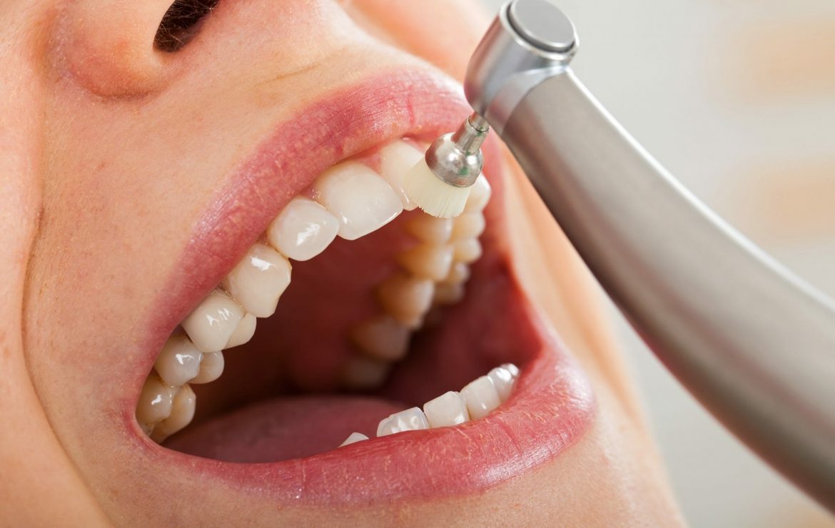 How Long Should a Dental Cleaning Take Dental Checkup