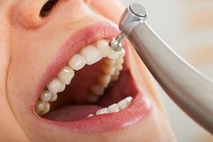 How Long Should a Typical Dental Cleaning Take?