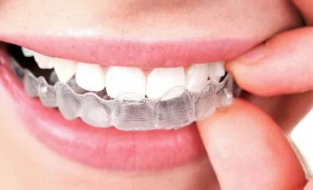 Invisalign is Finally Here: Everything You Need to Know!