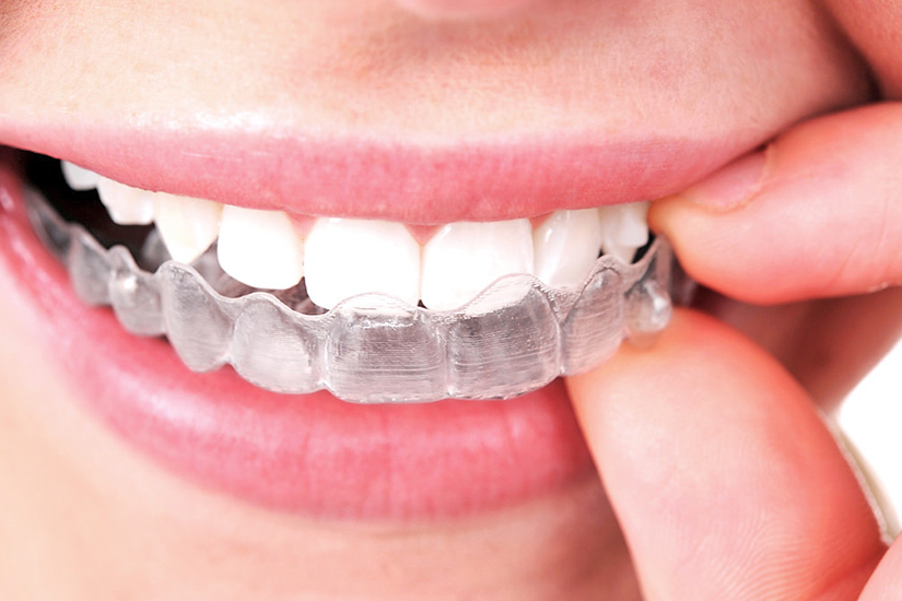 Invisalign is Finally Here: Everything You Need to Know!