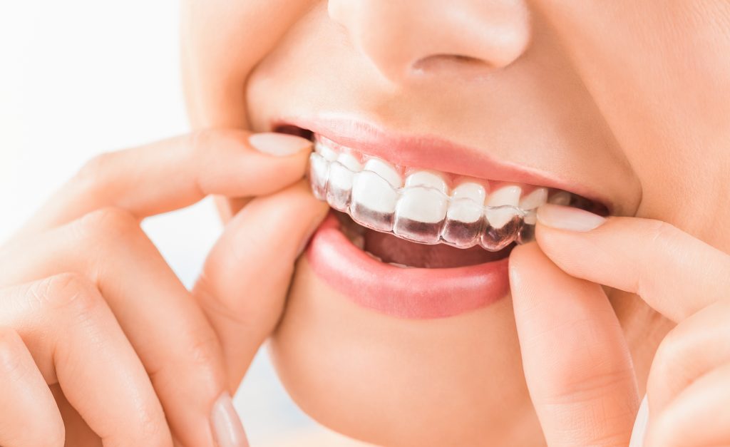 woman placing nightguard on her teeth