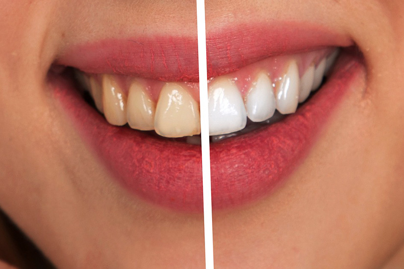 Teeth Whitening Info You Should Know