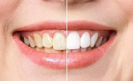 The Best Solution for Teeth Whitening