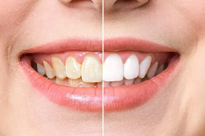 The Best Solution for Teeth Whitening