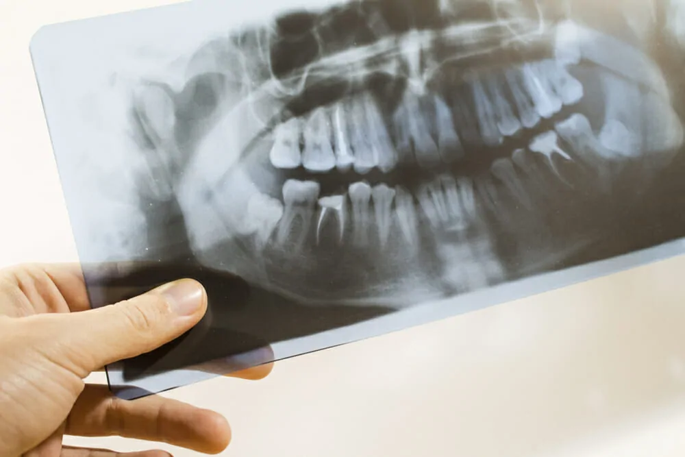 Are Dental X Rays Safe? | Why Do I Need Dental X Rays