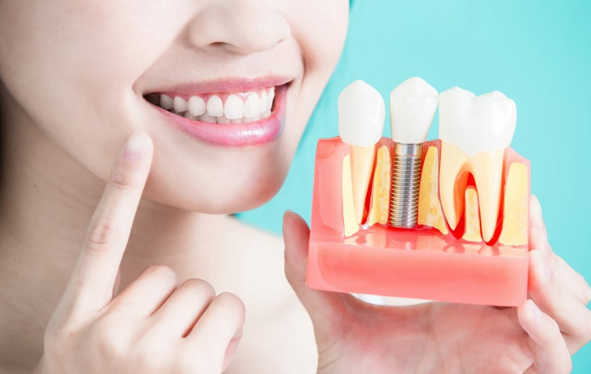 The Top 4 Benefits of Dental Implants