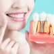 The Top 4 Benefits of Dental Implants