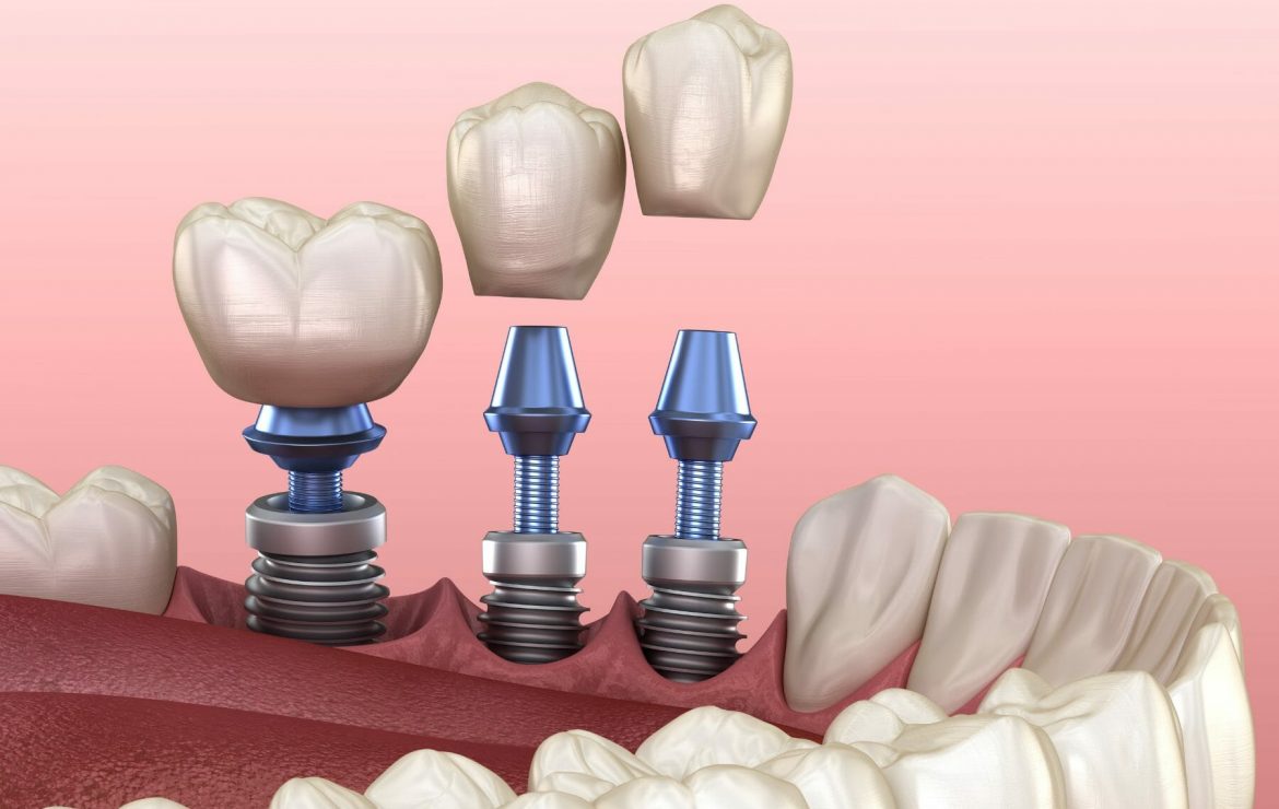 How Long Does It Take to Get Dental Implants?