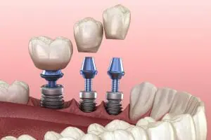 Dental Implant diagram