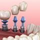 How Long Does It Take to Get Dental Implants?
